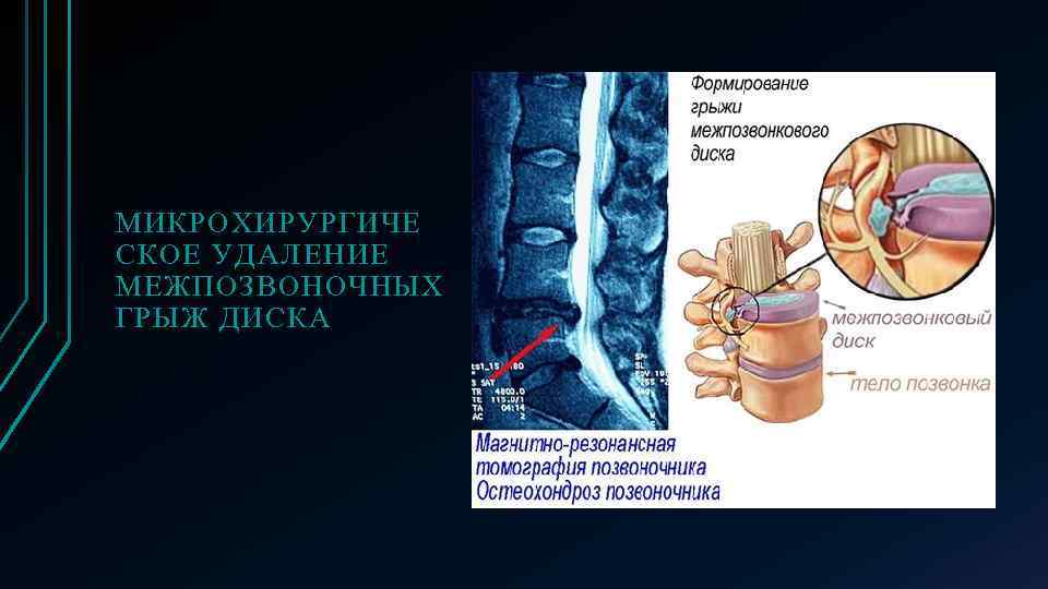 МИКРОХИРУРГИЧЕ СКОЕ УДАЛЕНИЕ МЕЖПОЗВОНОЧНЫХ ГРЫЖ ДИСКА 