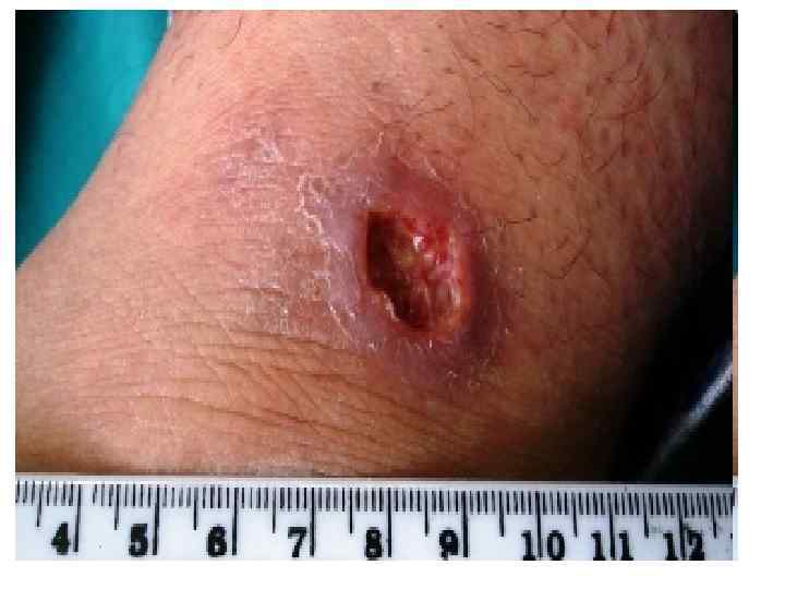  • Лейшманиозы (лат. Leishmaniasis) — группа паразитарных природно-очаговых, в основном зоонозных, трансмиссивных заболеваний,