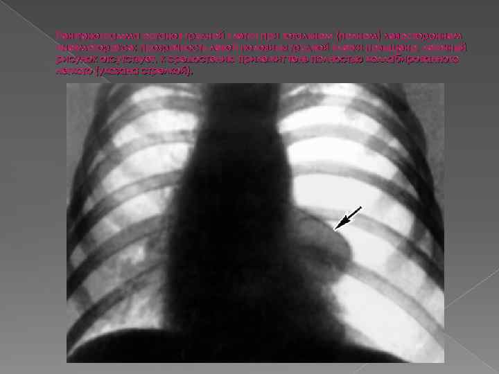 Рентгенограмма органов грудной клетки при тотальном (полном) левостороннем пневмотораксе: прозрачность левой половины грудной клетки
