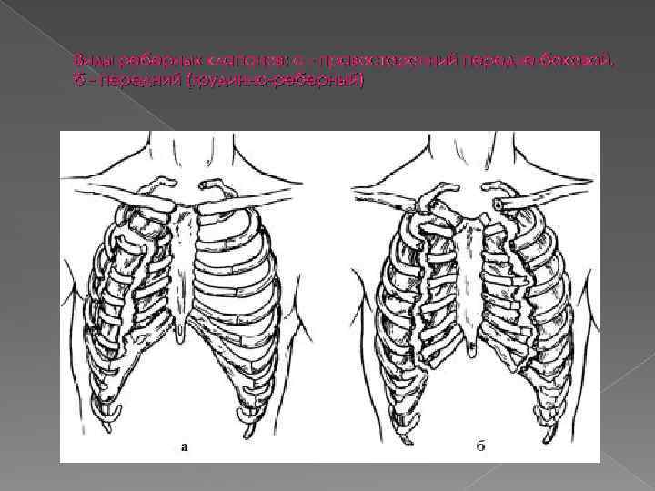 Виды реберных клапанов: а - правосторонний передне-боковой, б - передний (грудинно-реберный) 