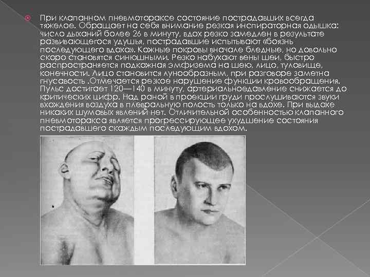  При клапанном пневмотораксе состояние пострадавших всегда тяжелое. Обращает на себя внимание резкая инспираторная