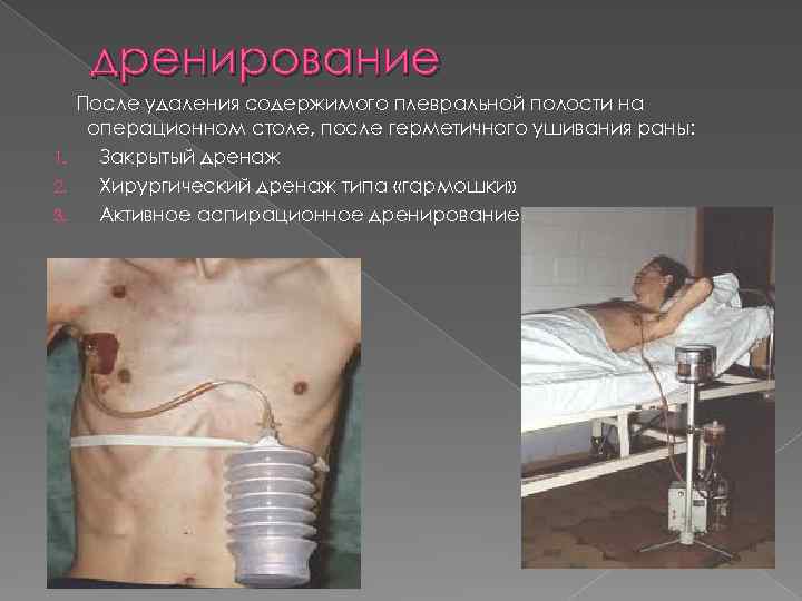 дренирование После удаления содержимого плевральной полости на операционном столе, после герметичного ушивания раны: 1.