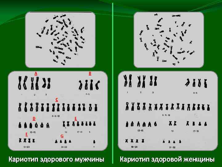 А В С D F E G Кариотип здорового мужчины Кариотип здоровой женщины 