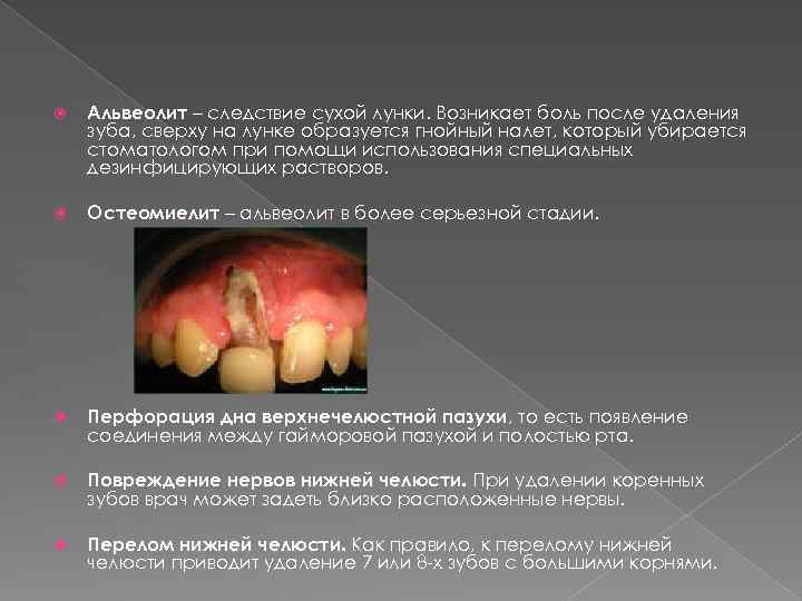  Альвеолит – следствие сухой лунки. Возникает боль после удаления зуба, сверху на лунке