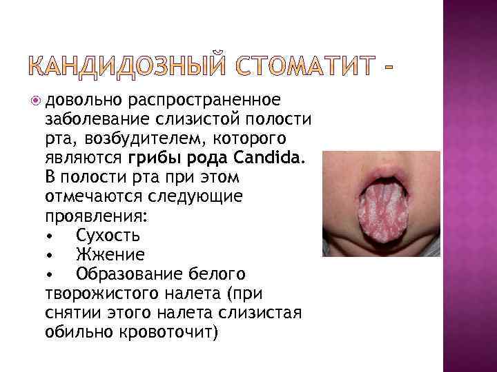  довольно распространенное заболевание слизистой полости рта, возбудителем, которого являются грибы рода Candida. В