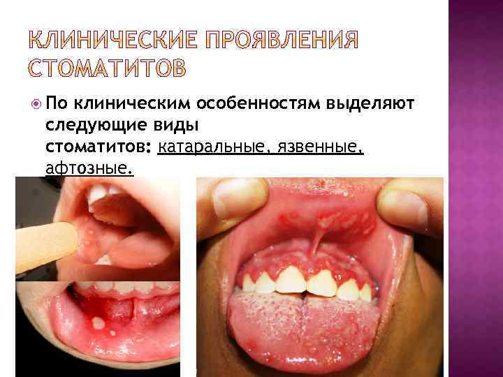  По клиническим особенностям выделяют следующие виды стоматитов: катаральные, язвенные, афтозные. 