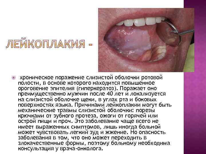  хроническое поражение слизистой оболочки ротовой полости, в основе которого находится повышенное ороговение эпителия