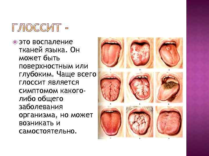  это воспаление тканей языка. Он может быть поверхностным или глубоким. Чаще всего глоссит