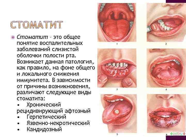  Стоматит – это общее понятие воспалительных заболеваний слизистой оболочки полости рта. Возникает данная