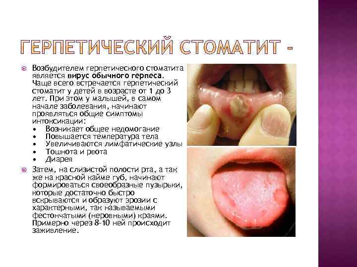  Возбудителем герпетического стоматита является вирус обычного герпеса. Чаще всего встречается герпетический стоматит у