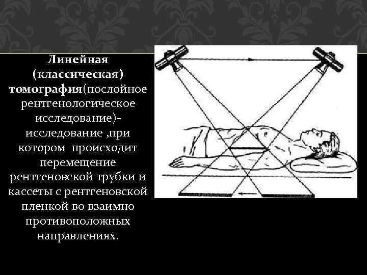 Линейная (классическая) томография(послойное рентгенологическое исследование)исследование , при котором происходит перемещение рентгеновской трубки и кассеты