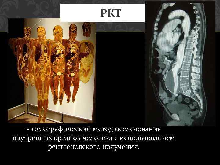 РКТ - томографический метод исследования внутренних органов человека с использованием рентгеновского излучения. 