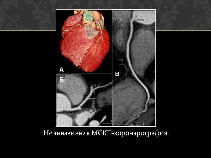 Кт сердца. Неинвазивная кт коронарография с контрастом. Мультиспиральная компьютерная томография коронарография. МСКТ коронарография сосудов.