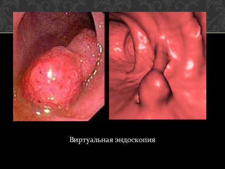 Виртуальная эндоскопия 