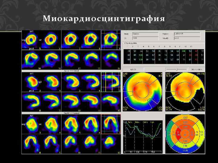 Миокардиосцинтиграфия 