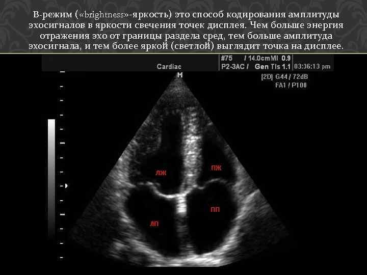B-режим ( «brightness» -яркость) это способ кодирования амплитуды эхосигналов в яркости свечения точек дисплея.