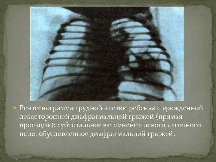  Рентгенограмма грудной клетки ребенка с врожденной левосторонней диафрагмальной грыжей (прямая проекция): субтотальное затемнение