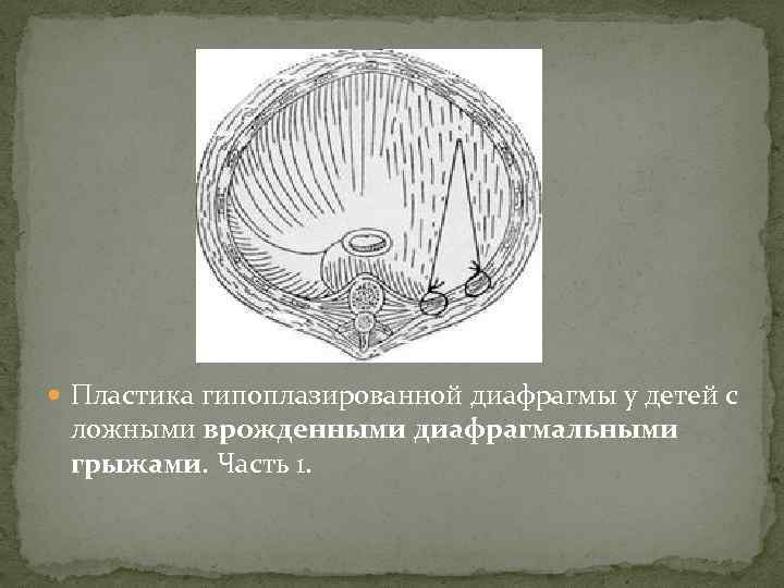  Пластика гипоплазированной диафрагмы у детей с ложными врожденными диафрагмальными грыжами. Часть 1. 