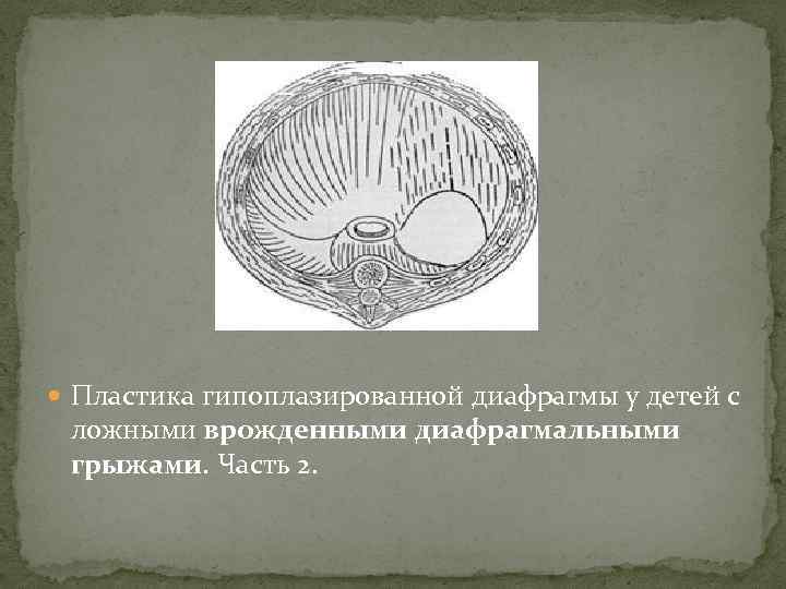  Пластика гипоплазированной диафрагмы у детей с ложными врожденными диафрагмальными грыжами. Часть 2. 