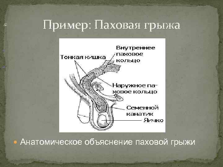 Паховая грыжа у мужчин где находится картинка причины симптомы и причины