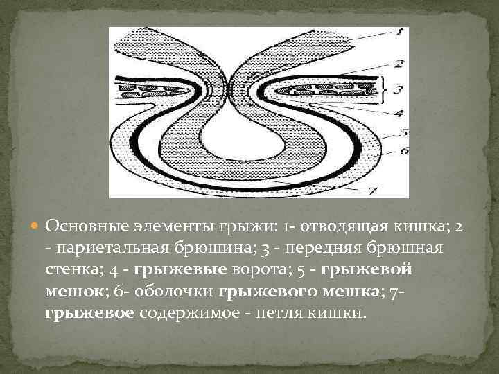  Основные элементы грыжи: 1 - отводящая кишка; 2 - париетальная брюшина; 3 -