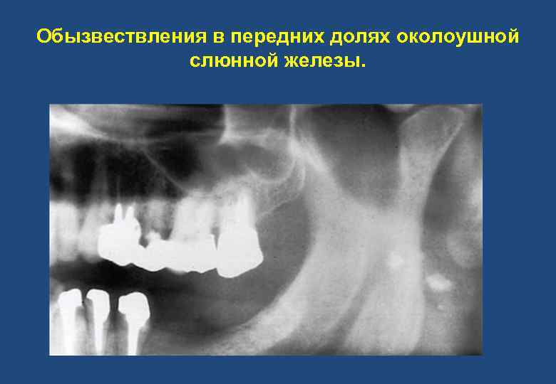 Обызвествления в передних долях околоушной слюнной железы. 