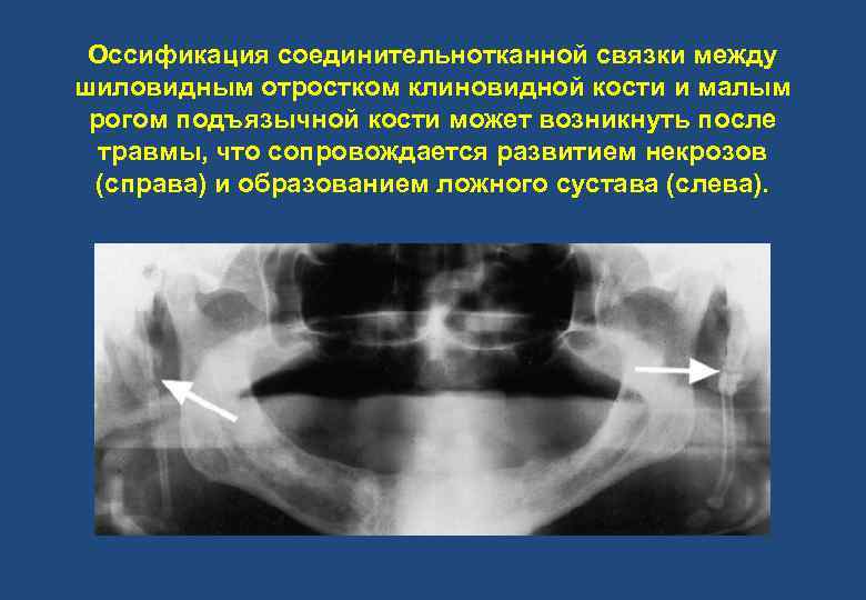 Оссификация соединительнотканной связки между шиловидным отростком клиновидной кости и малым рогом подъязычной кости может