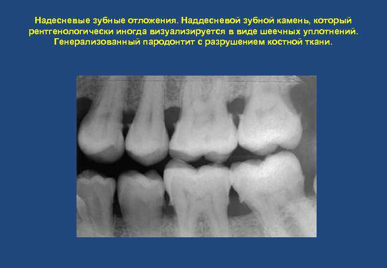 Зубные отложения презентация