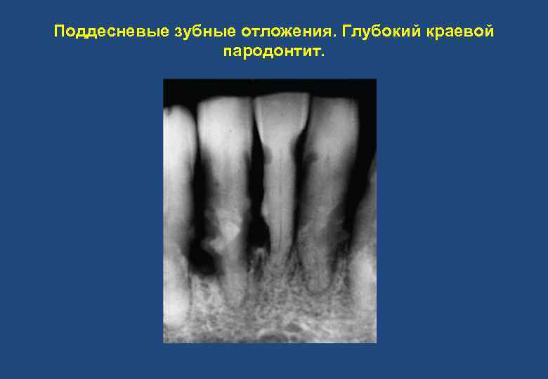 Поддесневые зубные отложения. Глубокий краевой пародонтит. 