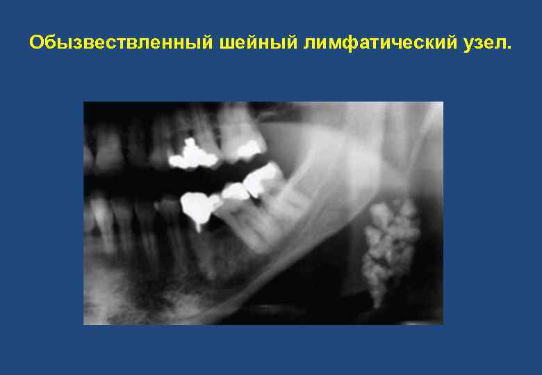 Обызвествленный шейный лимфатический узел. 
