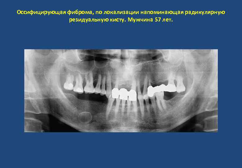 Оссифицирующая фиброма, по локализации напоминающая радикулярную резидуальную кисту. Мужчина 57 лет. 