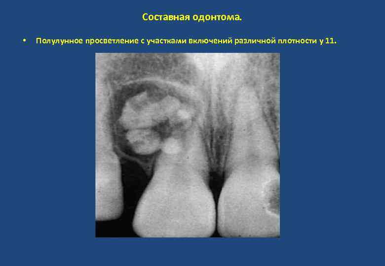 Составная одонтома. • Полулунное просветление с участками включений различной плотности у 11. 