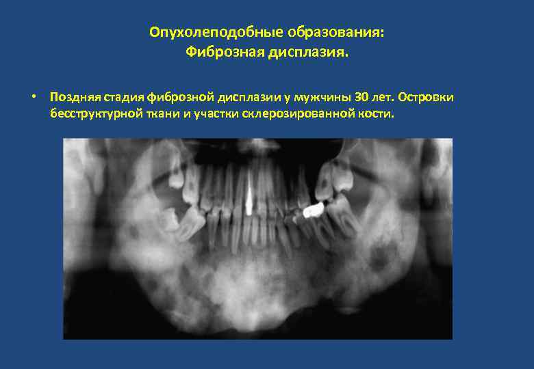 Опухолеподобные образования: Фиброзная дисплазия. • Поздняя стадия фиброзной дисплазии у мужчины 30 лет. Островки