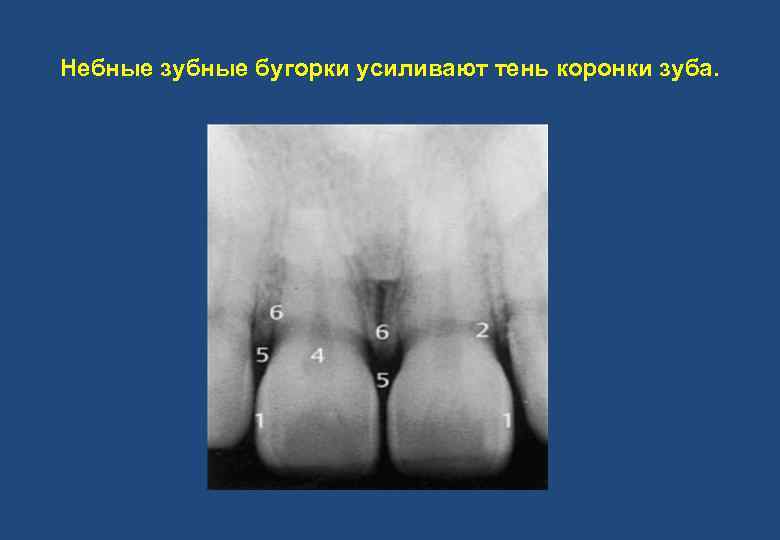 Небные зубные бугорки усиливают тень коронки зуба. 