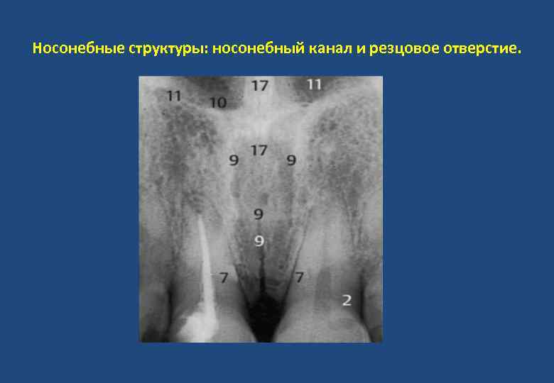 Носонебные структуры: носонебный канал и резцовое отверстие. 