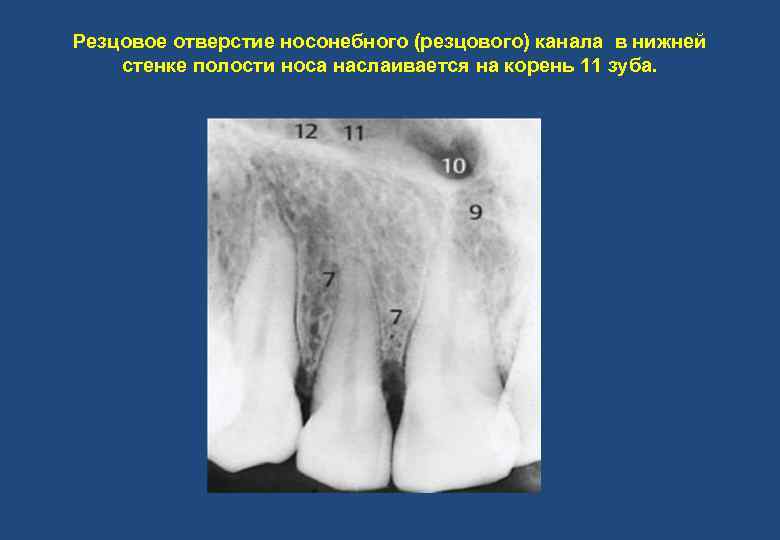 Резцовое отверстие носонебного (резцового) канала в нижней стенке полости носа наслаивается на корень 11