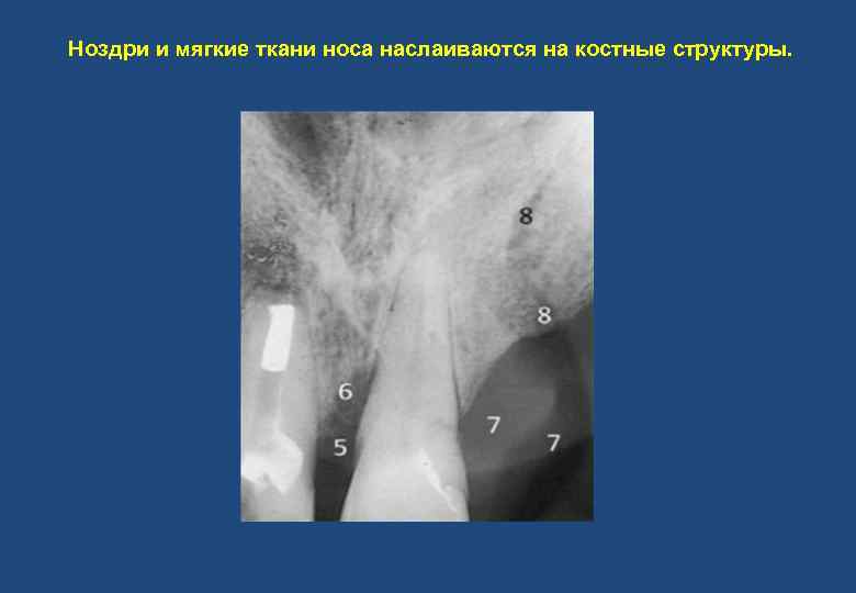 Ноздри и мягкие ткани носа наслаиваются на костные структуры. 