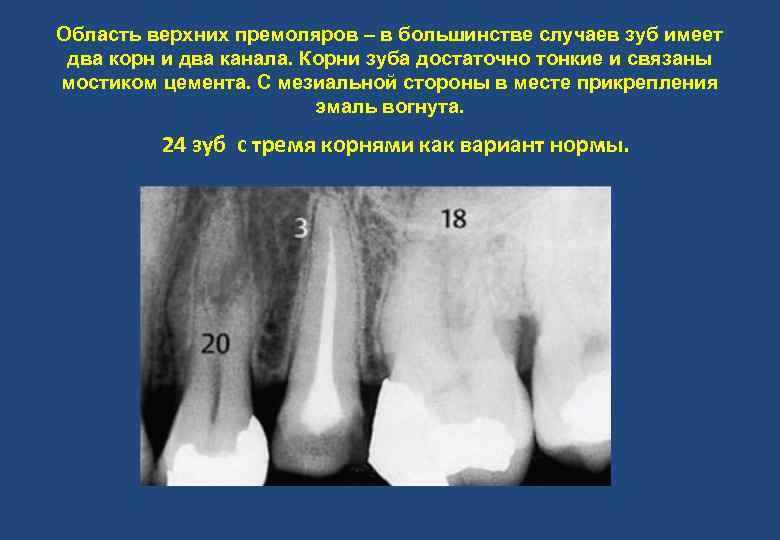 Область верхних премоляров – в большинстве случаев зуб имеет два корн и два канала.