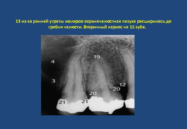 13 из-за ранней утраты моляров верхнечелюстная пазуха расширилась до гребня челюсти. Вторичный кариес на