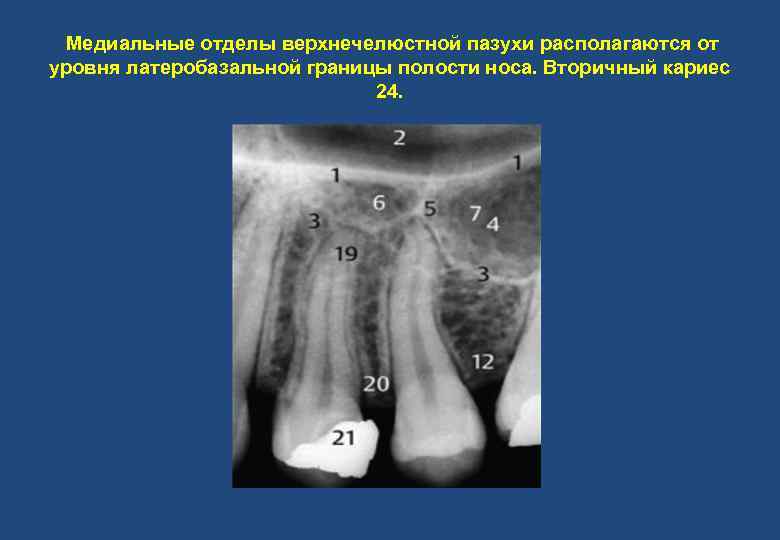 Медиальные отделы верхнечелюстной пазухи располагаются от уровня латеробазальной границы полости носа. Вторичный кариес 24.