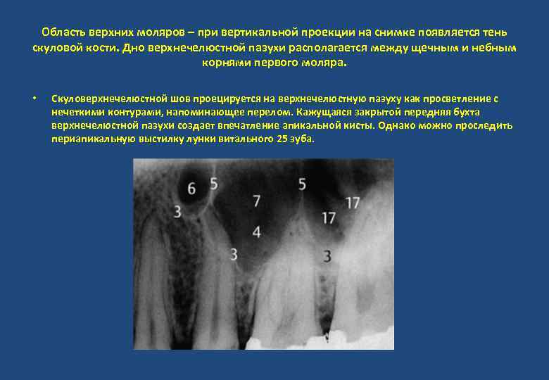 Область верхних моляров – при вертикальной проекции на снимке появляется тень скуловой кости. Дно