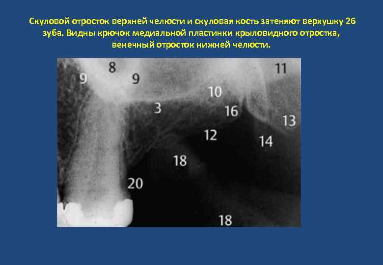 Скуловой отросток верхней челюсти и скуловая кость затеняют верхушку 26 зуба. Видны крючок медиальной