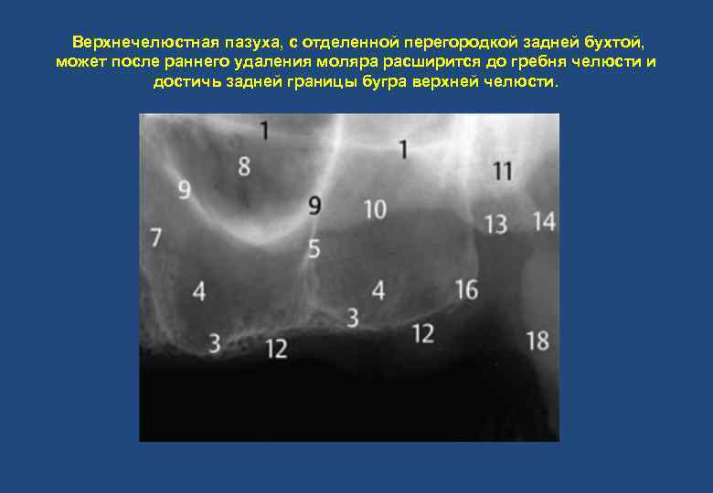 Верхнечелюстная пазуха, с отделенной перегородкой задней бухтой, может после раннего удаления моляра расширится до