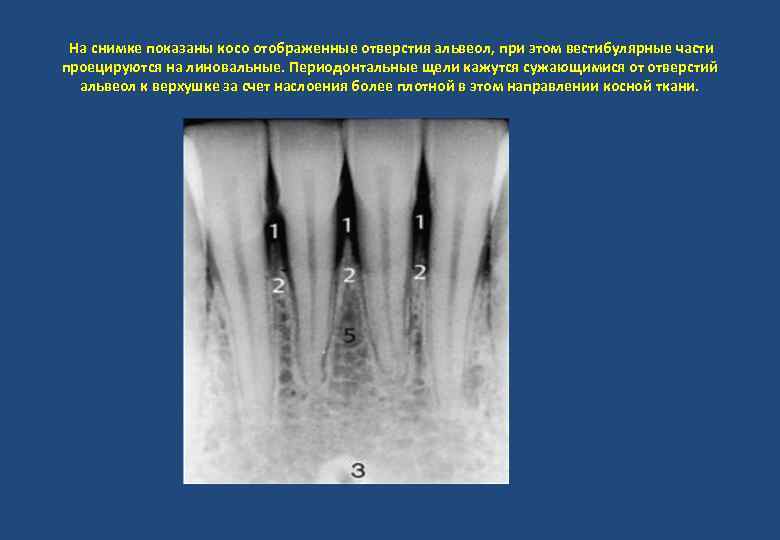 На снимке показаны косо отображенные отверстия альвеол, при этом вестибулярные части проецируются на линовальные.