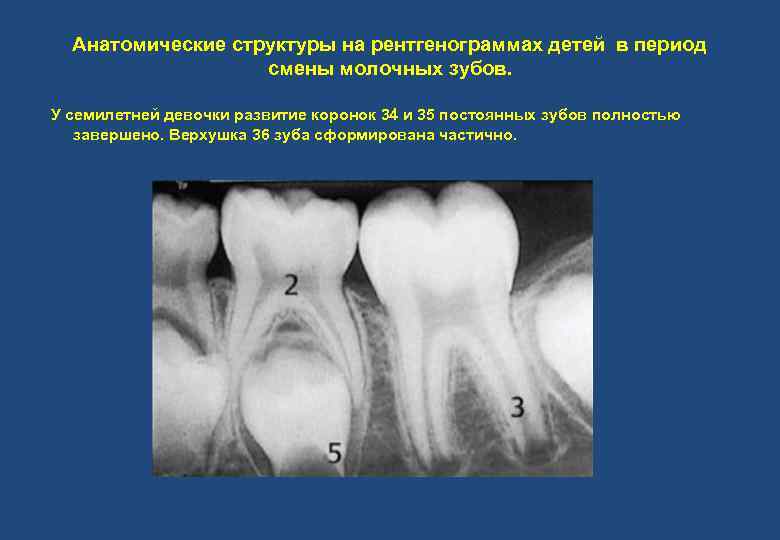 Анатомические структуры на рентгенограммах детей в период смены молочных зубов. У семилетней девочки развитие