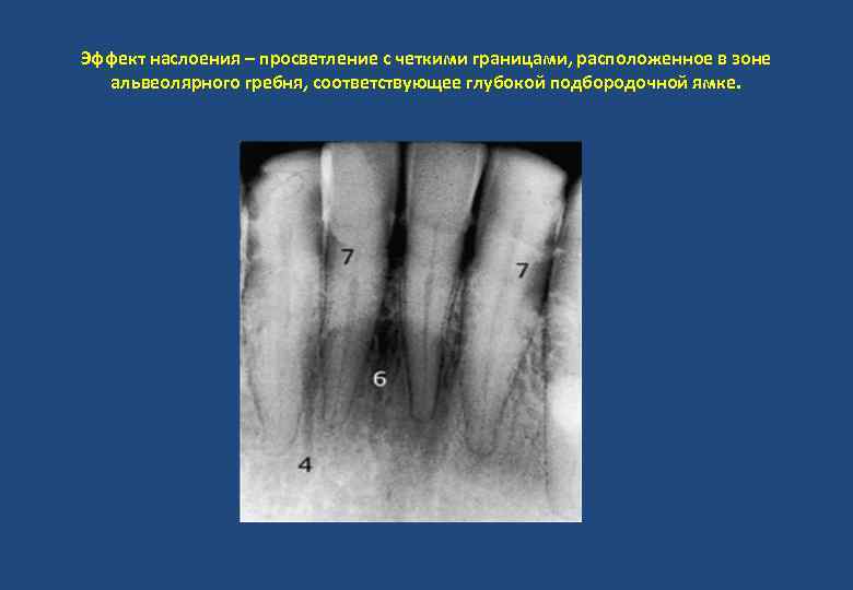 Эффект наслоения – просветление с четкими границами, расположенное в зоне альвеолярного гребня, соответствующее глубокой