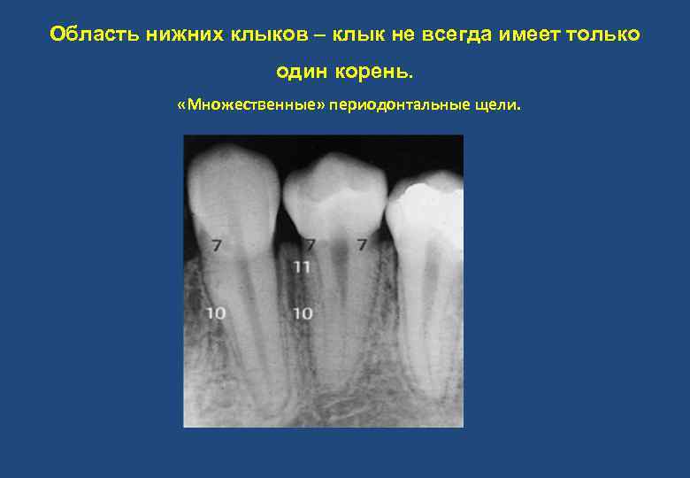 Область нижних клыков – клык не всегда имеет только один корень. «Множественные» периодонтальные щели.