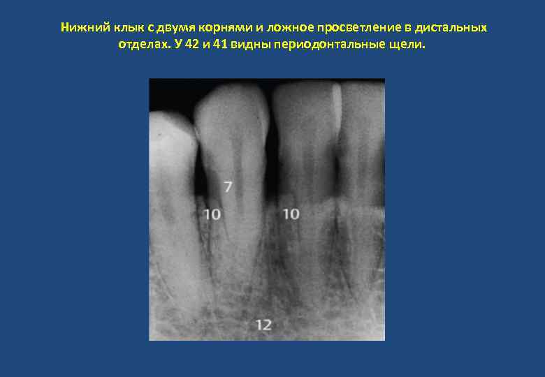 Нижний клык с двумя корнями и ложное просветление в дистальных отделах. У 42 и