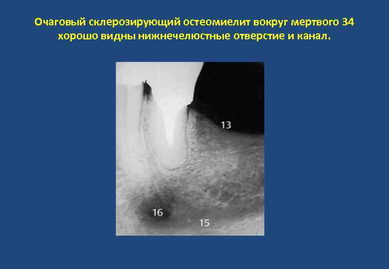 Очаговый склерозирующий остеомиелит вокруг мертвого 34 хорошо видны нижнечелюстные отверстие и канал. 