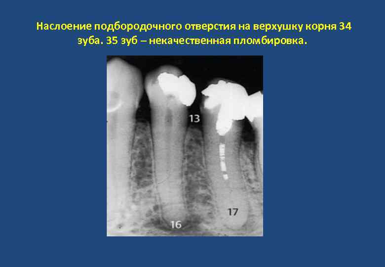 Наслоение подбородочного отверстия на верхушку корня 34 зуба. 35 зуб – некачественная пломбировка. 